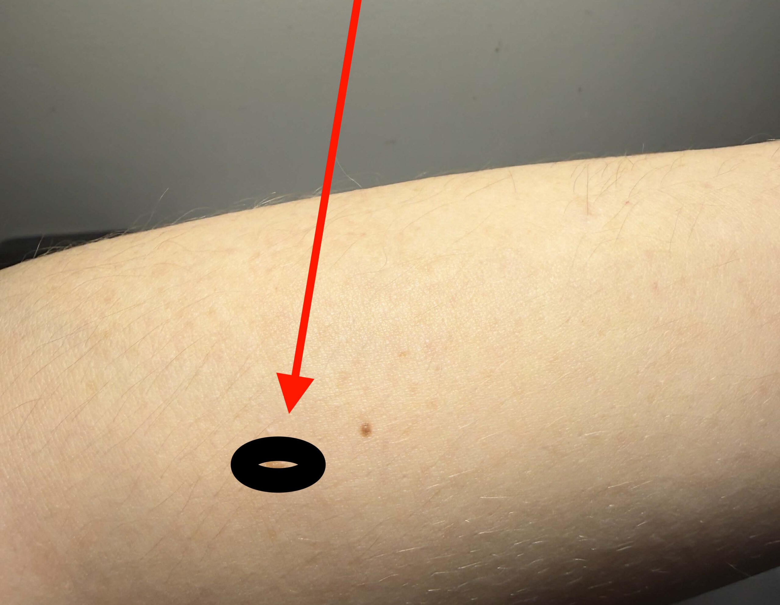 Uwaga na nowe „pieprzyki”. W Warszawie i regionie plaga nimf kleszcza, nasz redaktor pokazał to na własnej skórze [ZDJĘCIA]