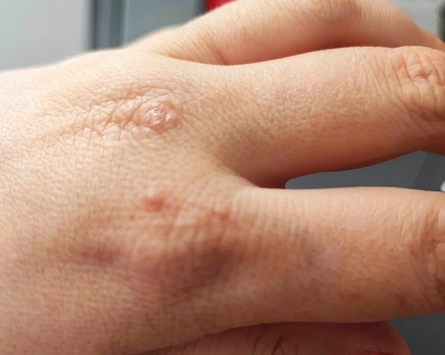 Po upałach Polacy masowo szukają dermatologów. Zauważyłeś swędzące grudki? Na wizytę poczekasz choćby 686 dni